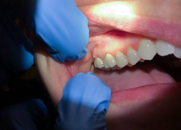 Best Emergency Dental Care for Abscessed Tooth in Culver, OR